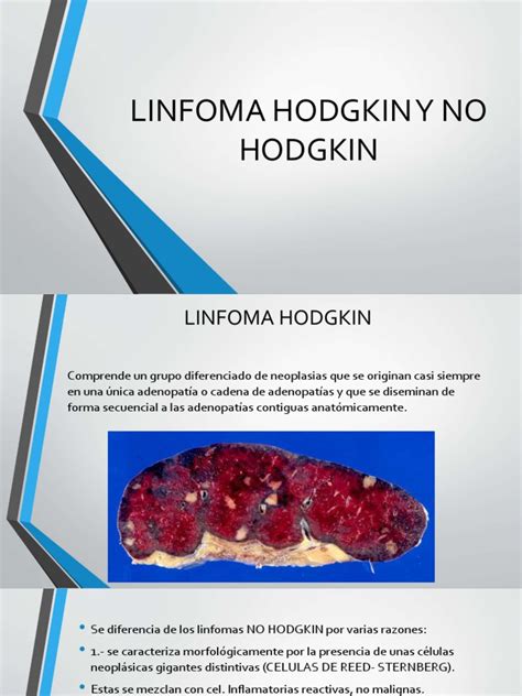 linfoma de hodgkin pdf